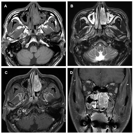 MRI PNS With Contrast